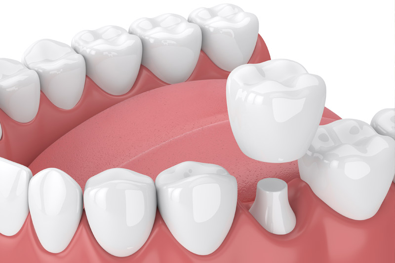 Dental Crowns in Huntington Park