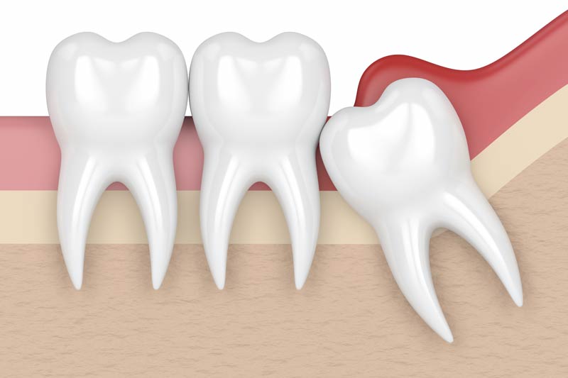 Wisdom Tooth Removal in Huntington Park